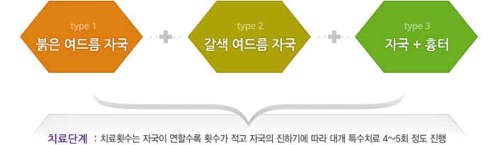 type1 붉은 여드름자국 + type2 갈색 여드름 자국 + type3 자국+흉터
= 치료단계 : 치료횟수는 자국이 연할수록 횟수가 적고 자국의 진하기에 따라 대개 특수치료 4~5회 정도 진행