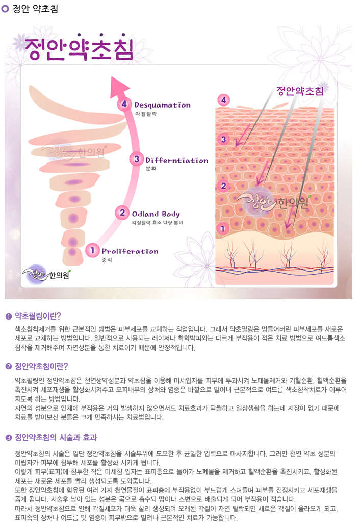 정안약초침
약초필링이란?
- 색소침착제거를 위한 근본적인 방법은 피부세포를 교체하는 작업입니다.
그래서 약초필링은 멍들어버린 피부세포를 새로운 세포로 교체하는 방법입니다.
일반적으로 사용되는 레이저나 화학박피는 다르게 부작용이 적은 치료 방법으로 여드름색소침착을 제거해주며 자연성분을 통한 치료이기 때문에 안정적입니다.
정안약초침이란?
약초필링인 정안약초침은 천연생약성분과 약초침을 이용해 미세입자를 통한 노폐물제거와 기혈순환과 혈액순환을 촉진시켜 세포재생을 활성화시켜주고 표피내부의 상처와 염증은 바깥으로 밀어내 근본적으로 여드름 색소침착치료가 이루어지도록 하는 방법입니다.
자연의 성분으로 인체에 부작용은 거의 발생하지 않으면서도 치료효과가 탁월하고 일상생활을 하는데 지장이 없기 때문에 치료를 받아보신 분들은 크게 만족하시는 치료법입니다.
정안약초침의 시술과 효과
정안약초침의 시술은 일단 정안약초침을 시술부위에 도포한 후 균일한 압력으로 마사지합니다. 그러면 천연 약초 성분의 미립자가 피부에 침투해 세포를 활성화 시키게 됩니다.
이렇게 피부(표피)에 침투한 작은 미세침 입자는 표피층으로 들어가 노폐물을 제거하고 혈액순환을 촉진시키고, 활성화된 세포는 새로운 세포를 빨리 생성되도록 도와줍니다.
또한 정안약초침에 함유된 여러 가지 천연물질이 표피층에 부작용없이 부드럽게 스며들며 피부를 진정시키고 세포재생을 돕게 됩니다. 시술후 남아 있는 성분은 몸으로 흡수되 땀이나 소변으로 배출되게 되어 부작용이 적습니다.
따라서 정안약초침으로 인해 각질세포가 더욱 빨리 생성되며 오래된 각질이 자연 탈락되면 새로운 각질이 올라오게 되고, 표피속의 상처나 여드름 및 염증이 피부밖으로 밀려나 근본적인 치료가 가능합니다.