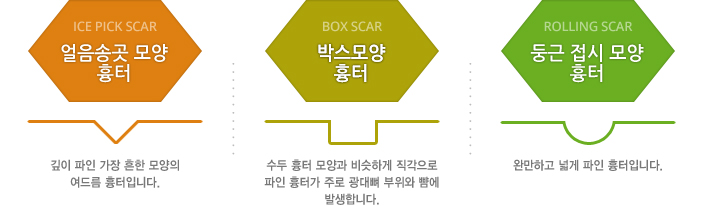 ·얼음송곳모양 흉터(ice pick scar) - 깊이 파인 가장 흔한 모양의 여드름흉터입니다.
박스모양 흉터(box scar) - 수두 흉터 모양과 비슷하게 직각으로 파인 흉터가 주로 광대뼈 부위와 뺨에 발생합니다.
둥근 접시 모양 흉터(rolling scar) - 완만하고 넓게 파인 흉터입니다.