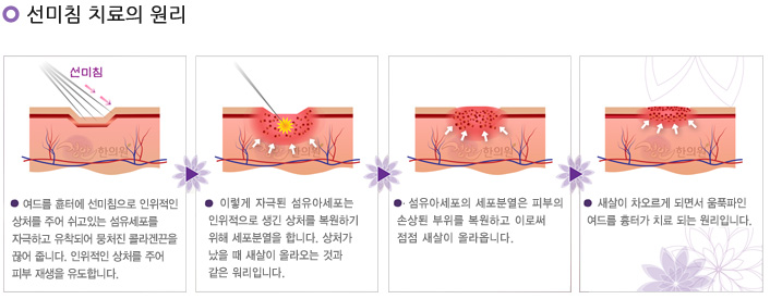 정안한의원 선미침
여드름 휸터에 선미침으로 인위적인 상처를 주어 쉬고있는 섬유세포를 자극하고 유착되어 뭉처진 콜라겐끈을 끊어 줍니다. 
인위적인 상처를 주어 피부 재생을 유도합니다.
이렇게 자극된 섬유아세포는 인위적으로 생긴 상처를 복원하기 위해 세포분열을 합니다. 
상처가났을 때 새살이 올라오는 것과 같은 워리입니다.
섬유아세포의 세포분열은 피부의 손상된 부위를 복원하고 이로써 점점 새살이 올라옵니다.
새살이 차오르게 되면서 움푹파인 여드름 흉터가 치료 되는 원리입니다.